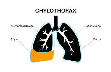 Chylothorax anatomical poster