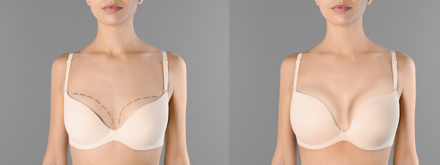 Breast augmentation with silicone implants. Photos of woman before with marks on skin and after with silicone implants, closeup. Collage design on grey background