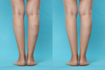 Before and after varicose veins treatment. Collage with photos of woman showing legs on light blue background, closeup