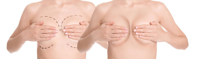 Breast augmentation surgery. Photos of woman before with marks on skin and after with silicone...