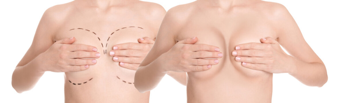 Breast augmentation surgery. Photos of woman before with marks on skin and after with silicone implants, closeup. Collage design on white background
