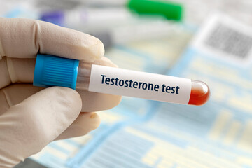Testosterone hormone test result with blood sample in test tube on doctor hand in medical lab a...