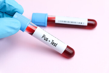Obraz premium Pus test, blood sample to analyze in the laboratory