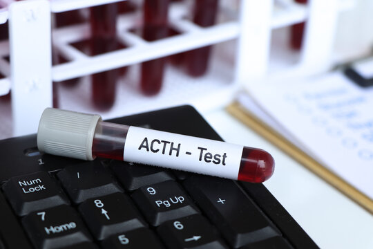 ACTH test, blood sample to analyze in the laboratory