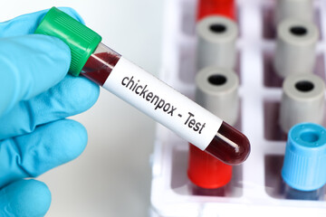 Obraz premium chickenpox test, blood sample to analyze in the laboratory