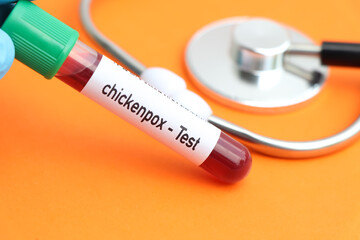 chickenpox test, blood sample to analyze in the laboratory