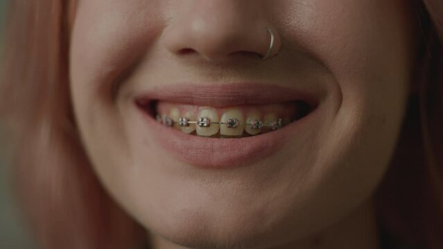 Female Mouth With Dental Braces Smiling At Camera. Close up teeth with braces in smile.