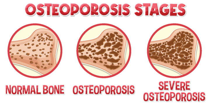 Informative poster of Osteoporosis human bone