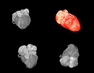 CTA Coronary artery  3D rendering image.