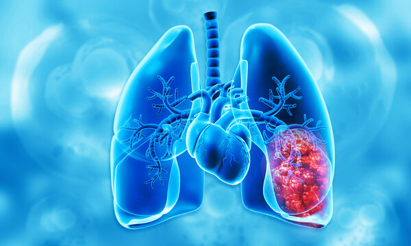 Cancer growth in human respiratory system. 3d illustration.