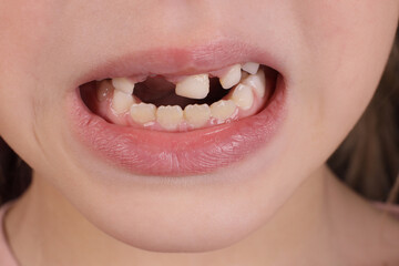 Mouth of a child without milk teeth close-up