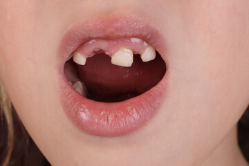 Mouth of a child without milk teeth close-up