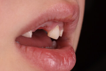 Mouth of a child without milk teeth close-up