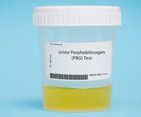 Urine porphobilinogen (PBG) test