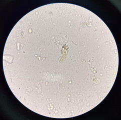 Cast in fresh urine finding with microscope.