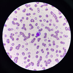 Atypical lympho cyte in red blood cell background.