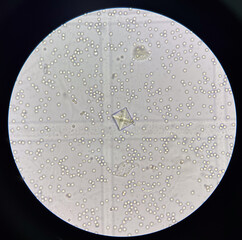 Calcium oxalate crystal in urine with moderate red blood cell.
