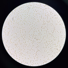 Fresh red blood cell in urine.