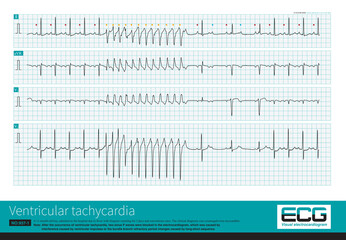 An 11 month old male infant was clinically diagnosed with cytomegalovirus myocarditis. The child experienced a brief atrioventricular block after a ventricular tachycardia attack.