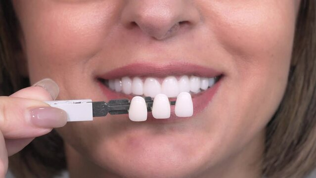 Whitening concept. Dental care, implants for veneers. Beautiful elderly Caucasian woman with perfect smile chooses tooth tone in dental clinic. Modern medicine.