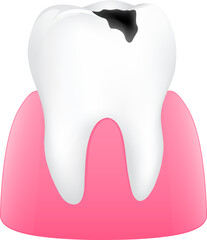 Unhealthy tooth. Tooth decay and gum. Dental care concept. Illustration.