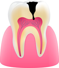 Unhealthy tooth. Tooth decay and gum. Dental care concept. Illustration.