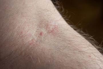 Small mark left by the needle on the elbow pit of a Caucasian male arm. Close up shot,...