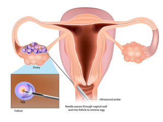 IVF Egg Retrieval technique. Egg retrieval procedure before in vitro fertilization. - obrazy, fototapety, plakaty
