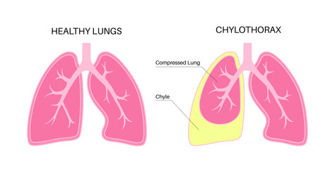 Chylothorax anatomical poster