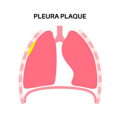 Pleural plaque poster