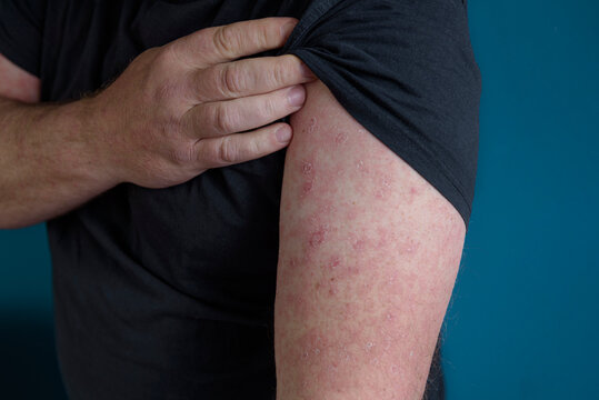 A red rash appears on the forearm. Erysipelas on the arm and upper part of the palm