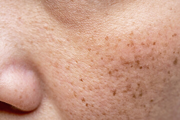 Woman's problematic skin pore and dark spots on the face