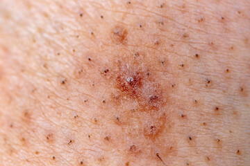 Closeup of caucasian skin with ingrown hair