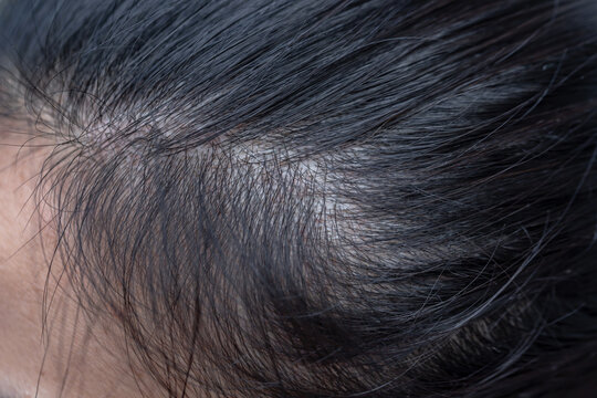 thinning hair on the head of an elderly woman