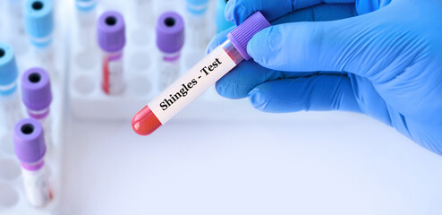 Doctor holding a test blood sample tube with Shingles test on the background of medical test tubes...