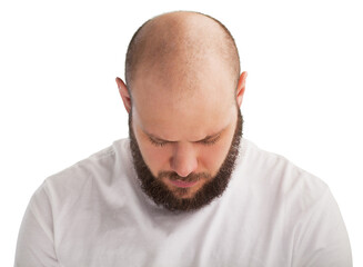 Hair loss treatment concept. Bald man - obrazy, fototapety, plakaty