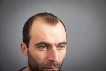 Fototapeta premium Caucasian man. Hair loss problem