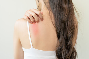Dermatology, asian young woman, girl allergy, allergic reaction from atopic, insect bites on her back, hand in scratching itchy, itch red spot or rash of skin. Healthcare, treatment of beauty.