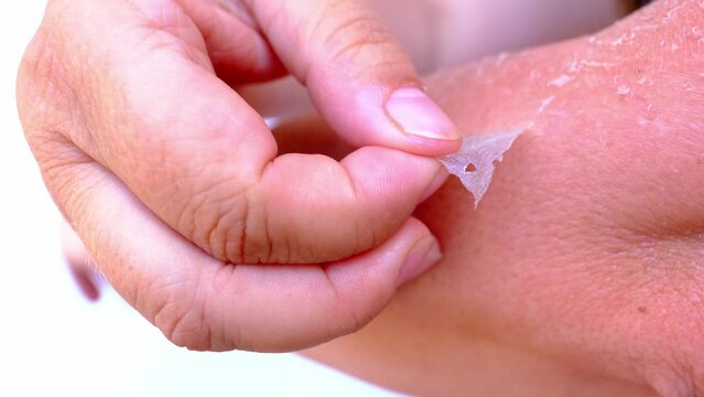 sunburn on skin, exfoliation of epithelium, severe peeling of the skin after sunburn, hands of an elderly woman in wrinkles close-up, harmful effects of sun, concept of beauty and spa procedures