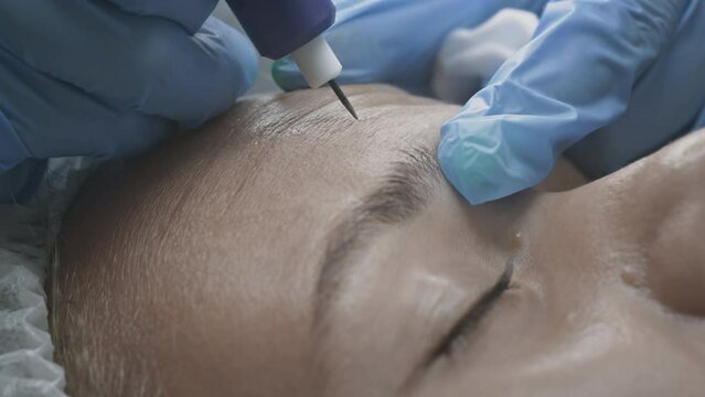 Woman patient at the cosmetologist dermatologist doctor. Smoothes forehead wrinkles with cryoplasma and argon coagulation surgery. Plasma lifting and facelift. Anti aging treatments. Exfoliate skin
