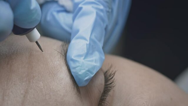 Woman patient at the cosmetologist dermatologist doctor. Smoothes forehead wrinkles with cryoplasma and argon coagulation surgery. Plasma lifting and facelift. Anti aging treatments. Exfoliate skin