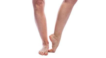 Women's legs up to the knees with spider veins without treatment. Problems with blood vessels. Activity and health. Without background.