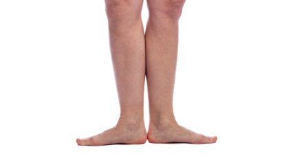 Women's legs up to the knees with spider veins without treatment. Problems with blood vessels. Activity and health. Without background.