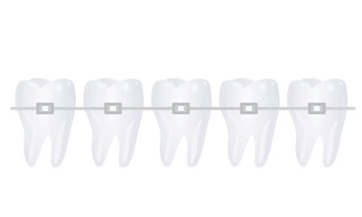 Braces on teeth. vector illustration