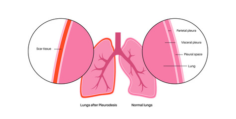 Pleurodesis medical procedure Generative AI