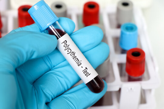 Polycythemia test, blood sample to analyze in the laboratory