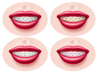 Obraz premium Realistic teeth dental braces. Smiling lips, orthodontic bite correction, tightening structures, different types metal, ceramic and sapphire, , health and beauty utter vector 3d isolated set