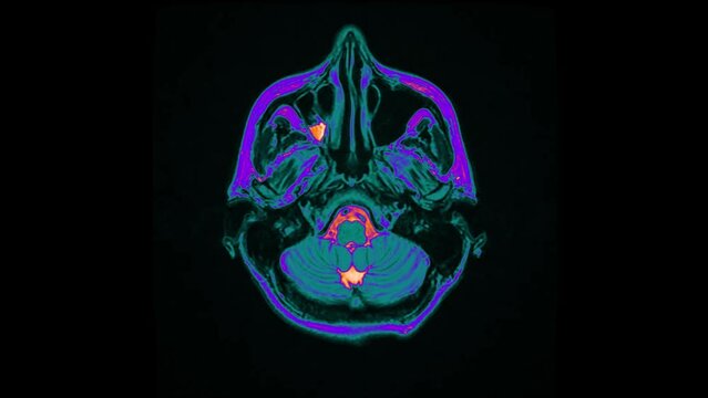 Colored MRI of the brain. Medical image for the study of internal organs and tissues, video.