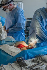 A doctor of heart surgery uncovers a vein on a leg to harvest it for heart bypass.  heart surgery...