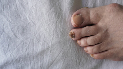 feet of a woman with a black nail. nail cancer .   nail disease    
